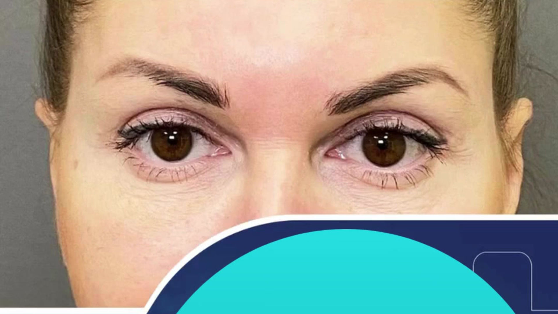 Blepharoplasty Upper/Lower